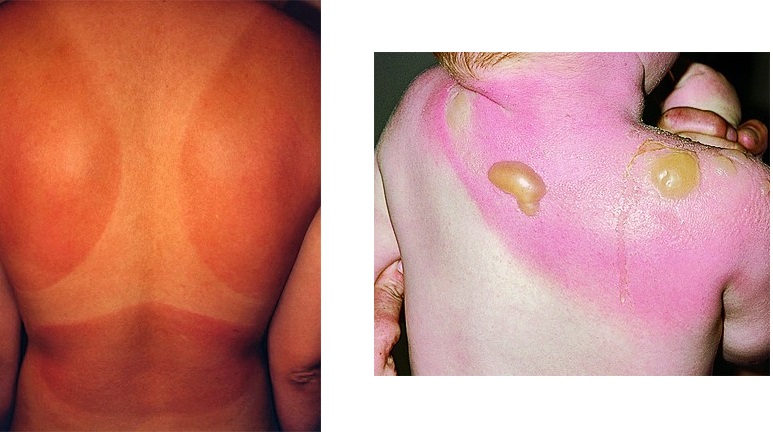 Im&aacute;genes quemaduras solares en el cuepor humano.